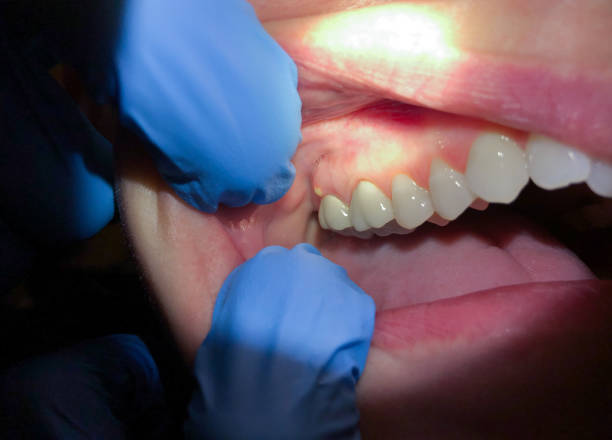 Best Emergency Dental Extractions in Sullivan, IN
